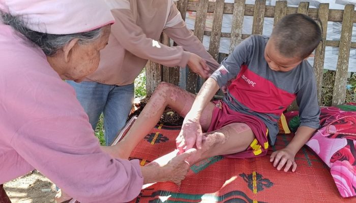 Kronologi 3 Santri di Lombok Tengah Diduga Dibakar Senior, Berawal dari Kamar Kosong yang Dikunci