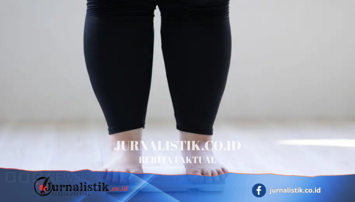 Kasus Obesitas Melonjak Paling Cepat pada Dewasa Muda di Inggris