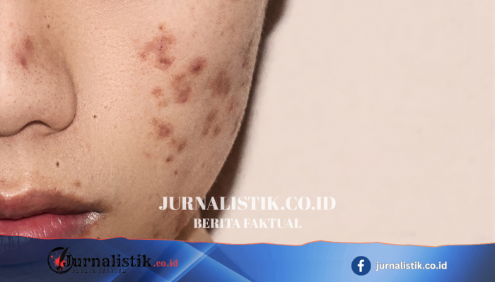 Viral NaCl Infus untuk Jerawat, dr. Arini: Normal Saline Dipakai Perawatan Medis, Bukan Skincare