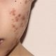 Viral NaCl Infus untuk Jerawat, dr. Arini: Normal Saline Dipakai Perawatan Medis, Bukan Skincare