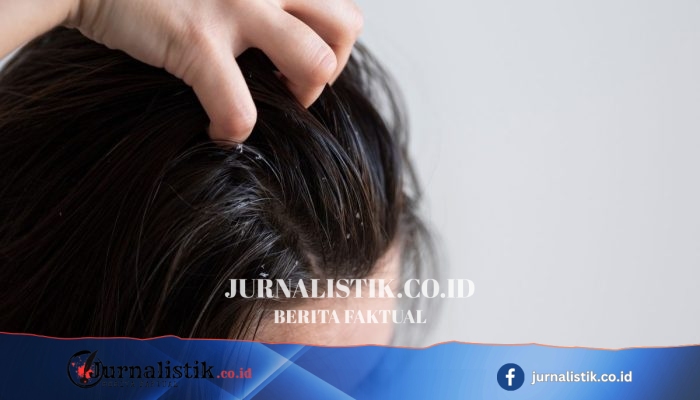 Ketombe dan Kulit Kepala Gatal: Benarkah Mengarah ke Rambut Rontok?