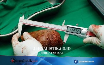 4 Indikasi Ginjal Bermasalah yang Terlihat dari Urine Saat Buang Air Kecil