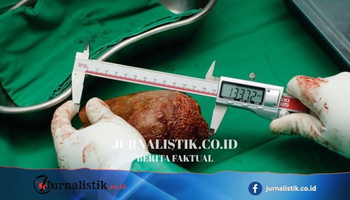 4 Indikasi Ginjal Bermasalah yang Terlihat dari Urine Saat Buang Air Kecil